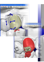 CAD技術を生かした歯列の移動予測