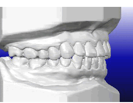 CAD技術を生かした歯列の移動予測